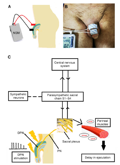 Transcutaneous dorsal penile nerve stimulation for the treatment